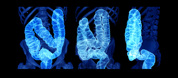 colorectal cancer KEYNOTE-177